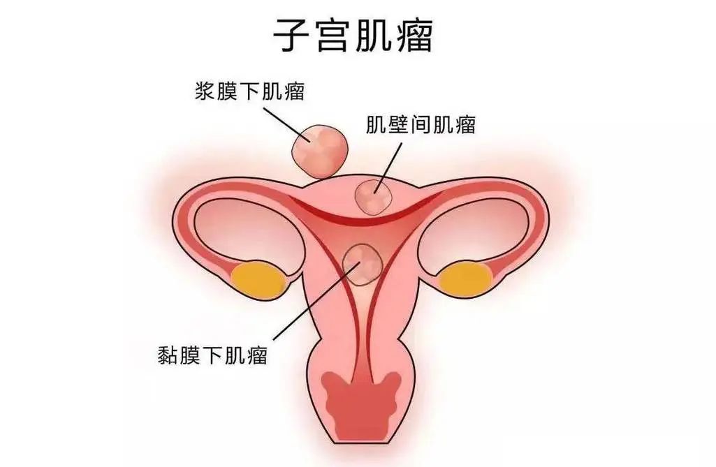 【微创介入 医学科普】不开刀、保子宫！介入医生揭秘子宫