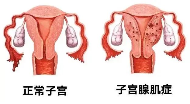 【微创介入 医学科普】痛经难忍？微创介入治疗